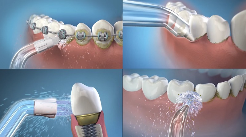 Máy tăm nước giúp loại bỏ tối đa mảng bám trên răng